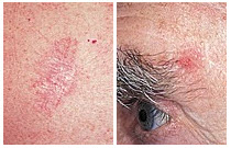 BCC-slider-2 picture basal cell carcinoma on man's left eyebrow