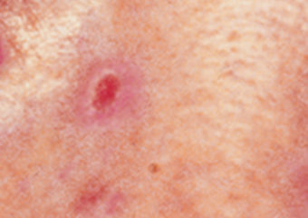 BCC_PinkGrowth-1 pink growth bcc