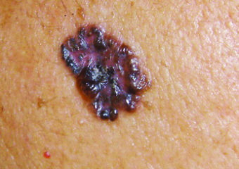 BCC_pigmented_Fitz_type_4_jpg_Bwr4Nu1C A basal cell carcinoma may be pigmented, like this one, on skin of color.