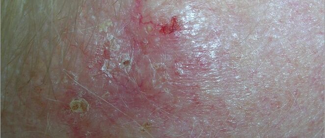 Basal cell carcinoma - a red, irritated patch
