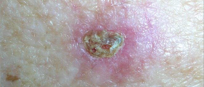 Basal cell carcinoma - a sore that does not heal