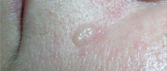 Basal cell carcinoma on cheek