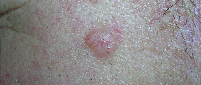 Basal cell carcinoma - shiny bump