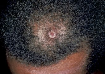 CSCC on the scalp of a Black man squamous cell carcinoma on the scalp of a Black man