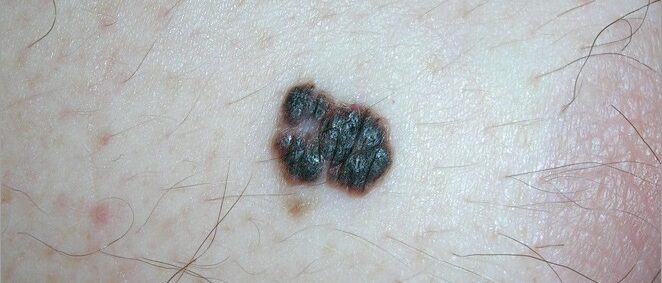 Dark, raised melanoma with irregular borders Dark, raised melanoma with irregular borders