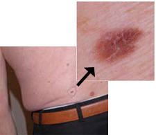 Dysplastic-nevus-lowerback Dysplastic nevus lowerback man
