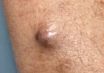 Gentry-MCC Merkel cell carcinoma