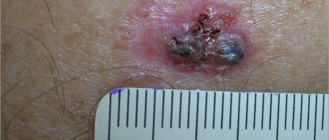Large basal cell carcinoma