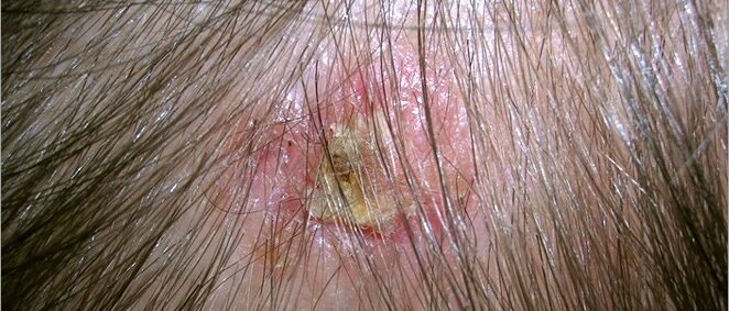 Large basal cell carcinoma on scalp