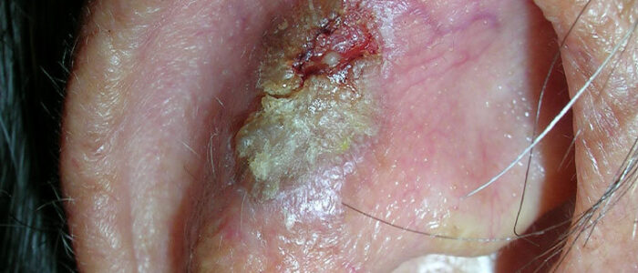Large, crusty squamous cell carcinoma on ear