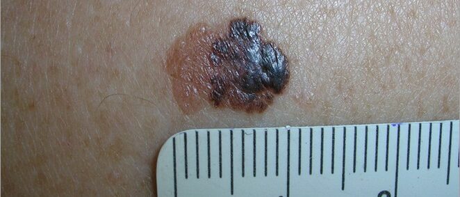 Large melanoma with varied colors Large melanoma with varied colors