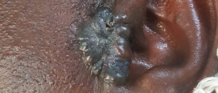 Large, pigmented basal cell carcinoma