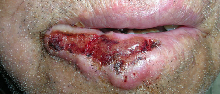 Large squamous cell carcinoma on lip