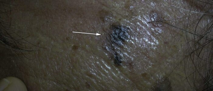 Melanoma, irregular borders Melanoma, irregular borders