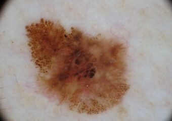 Melanoma3