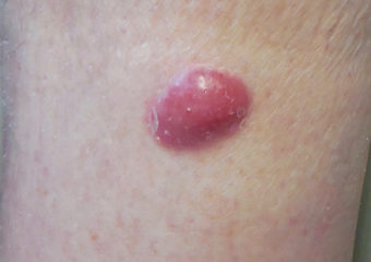 Merkel Cell Carcinoma merkel cell carcinoma on the lower leg
