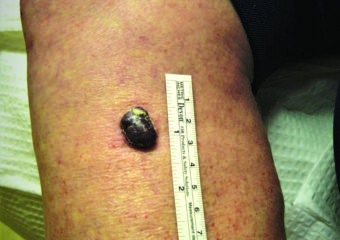 Nodular mm leg native American woman