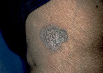 Pigmented BCC Pigmented BCC