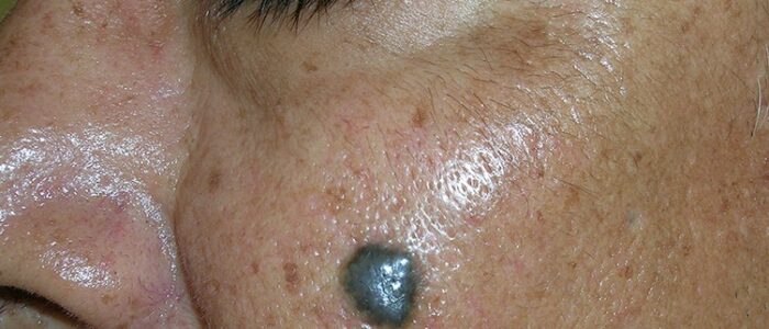 Pigmented basal cell carcinoma on cheek