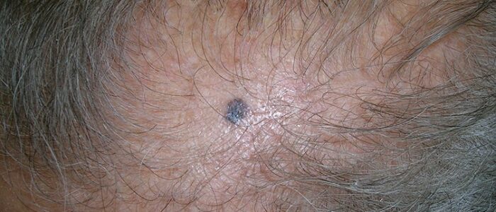 Pigmented basal cell carcinoma on scalp