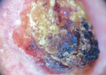 SCC2 Squamous cell carcinoma .Photo: International Skin Imaging Collaboration at isic-archive.com