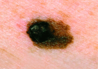 SCF - Dark melanoma with irregular borders