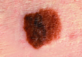 SCF Melanoma with irregular borders and differing colors