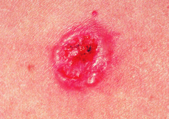 SCF_Basal cell carcinoma presenting as a pink growth