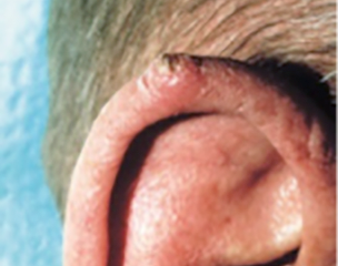 Squamous Cell Carcinoma 1 wart like on ear wart-like growth squamous cell carcinoma on ear