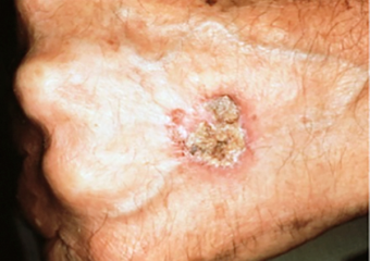 Squamous Cell Carcinoma 2 scaly patch on back of hand Patch on man hand squamous cell carcinoma