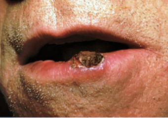 Squamous Cell Carcinoma 3 elevated growth on lip squamous cell carcinoma on lip
