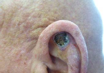 Squamous Cell Carcinoma - open sore that bleeds Picture open sore man left ear