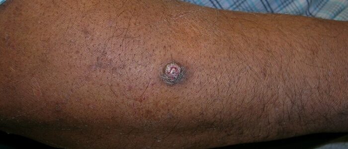 Squamous cell carcinoma on forearm of man with darker skin tone Squamous cell carcinoma on forearm of man with darker skin tone