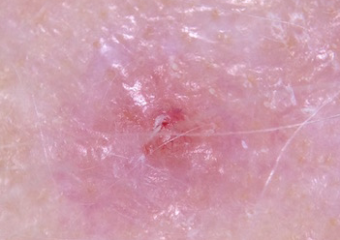 amelanotic-melanoma-scalp-crop A nodular melanoma developing within an amelanotic melanoma in situ on the scalp.
