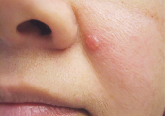 basal cell carcinoma 1 shiny bump picture shiny bump on woman's face