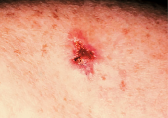 basal cell carcinoma 2 open sore an open sore on the skin basal cell carcinoma