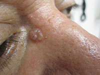 bcclatinoman_sm BCC on nose of Latino male