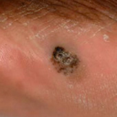 figure4a acral lentiginous melanoma