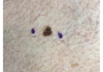 melanoma in situ 1 cm on the right calf melanoma in situ 1 cm on the right calf