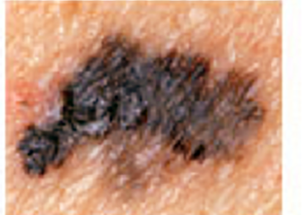 Melanoma_Border Picture mole with irregular border