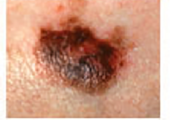 Melanoma_Color melanoma picture mole unconventional color