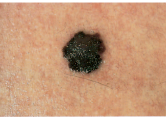 melanoma_5_Evolving_Now picture of melanoma evolving into bigger
