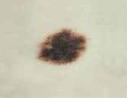 Picture of Melanoma Picture of melanoma skin cancer