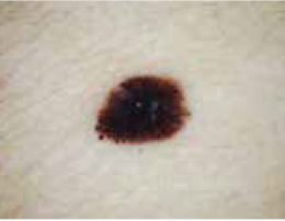 Picture of melanoma Picture of melanoma skin cancer
