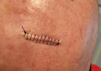 stitches after Mohs Surgery on forehead for squamous cell carcinoma
