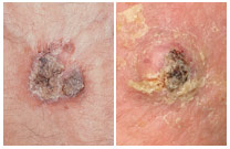 scc-1-1 Squamous cell carcinoma scaly patch